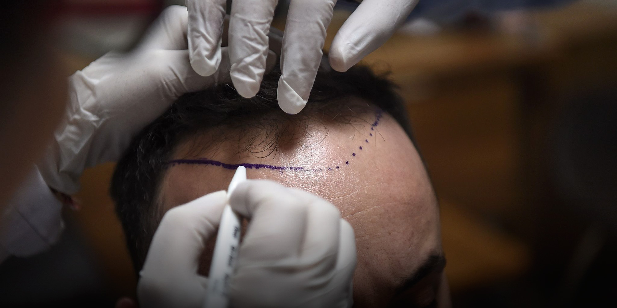 FUE DHI saç ekimi farkı