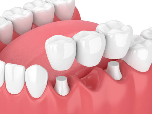 Dental Bridge in Turkey | EsteGo Clinic