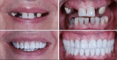 Dentes Separados (Diastema)