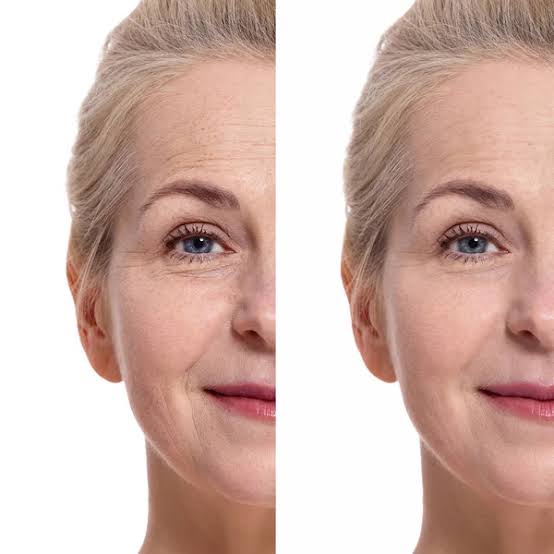 upper blepharoplasty