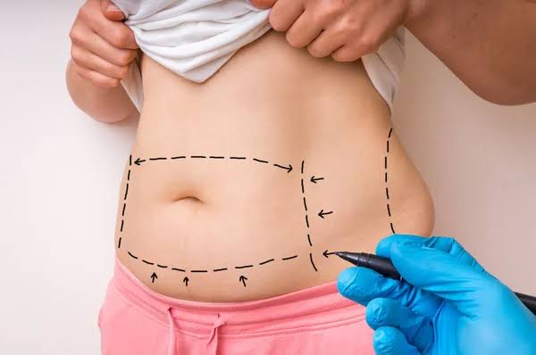 sixpack bauchstraffung