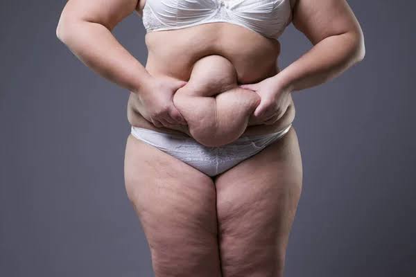 bauchstraffung mit liposuktion