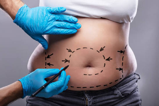 bauchstraffung flanken lipo