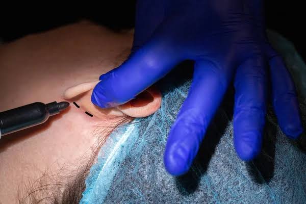 Ohrläppchen-Korrektur – gerissene und gedehnte Ohrläppchen an der EsteGo Clinic Istanbul