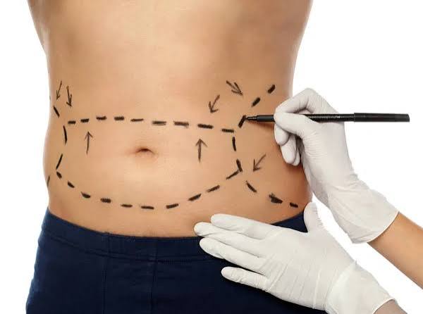 fettabsaugung liposuktion