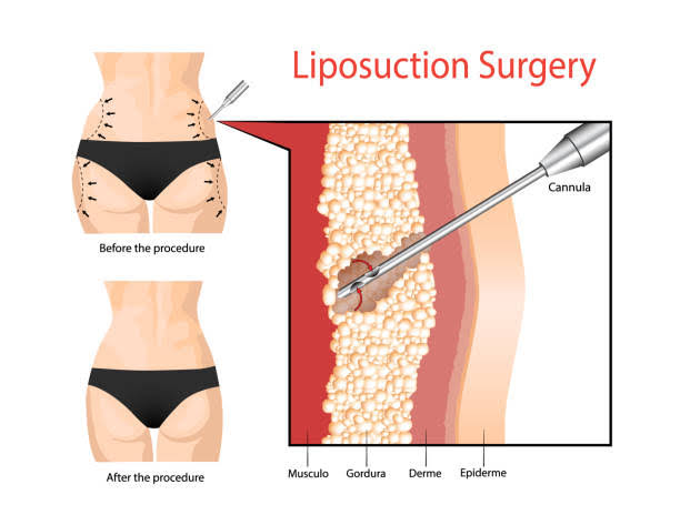 oberschenkelstraffung lipo