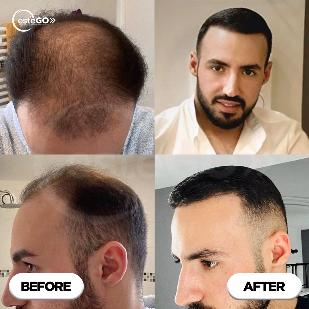 Hair transplant before and after comparison in Turkey