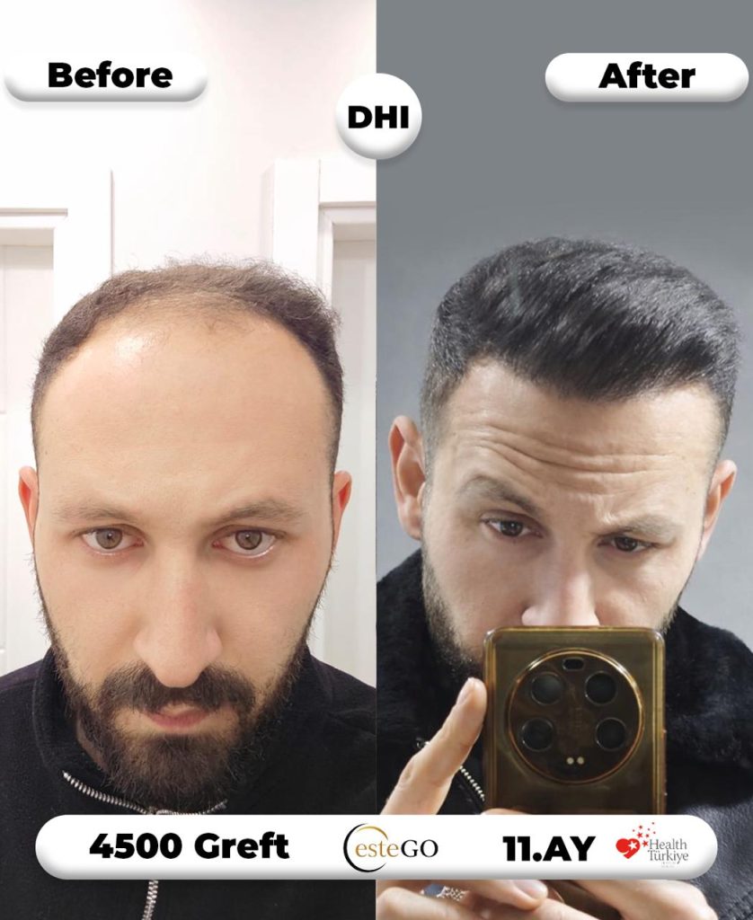 EsteGo saç ekimi öncesi sonrası