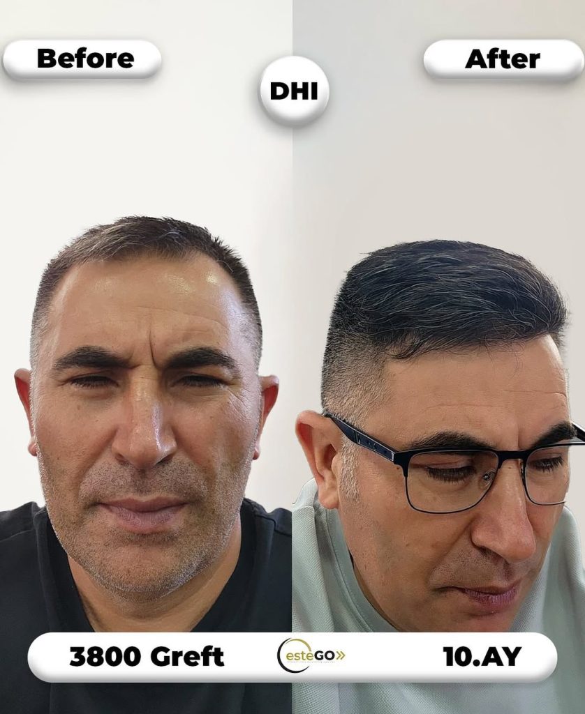 EsteGo saç ekimi öncesi sonrası