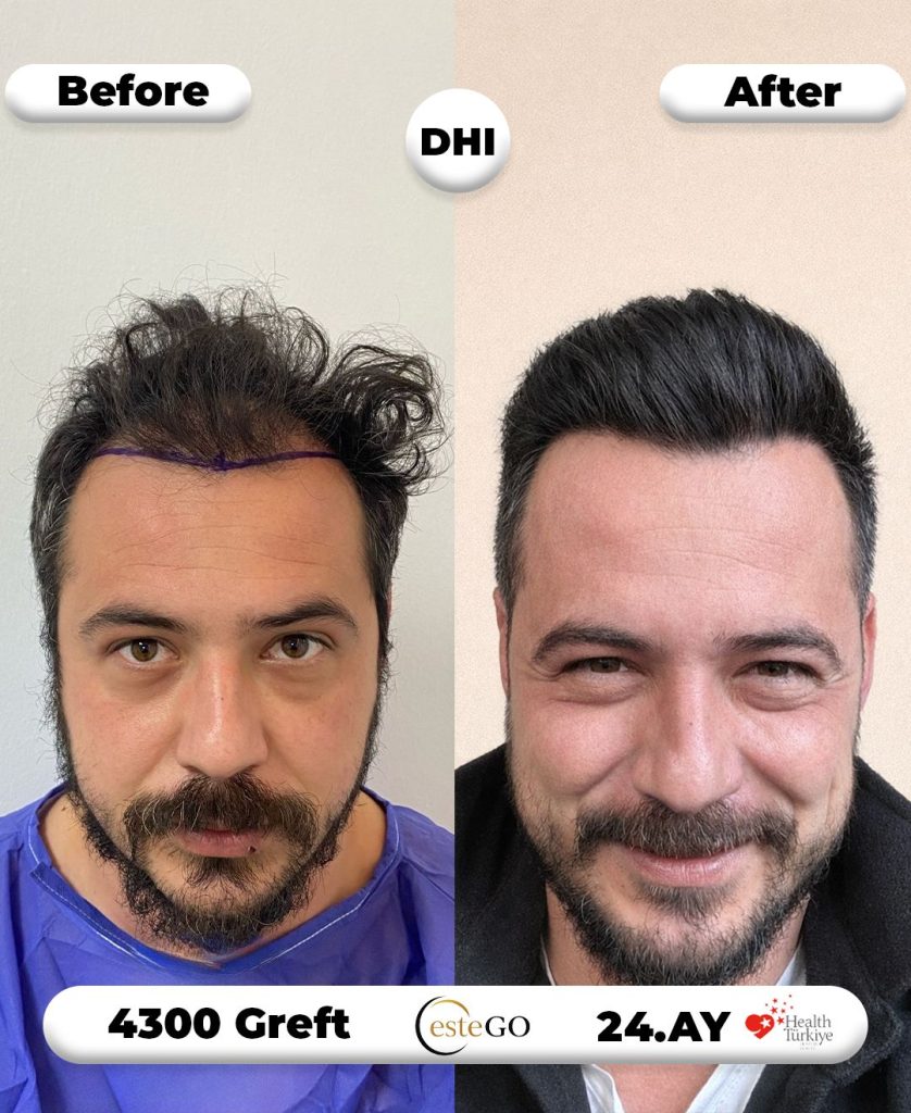 EsteGo saç ekimi öncesi sonrası