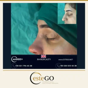 Kadın burun estetiği operasyon sonrası profil – EsteGo Clinic