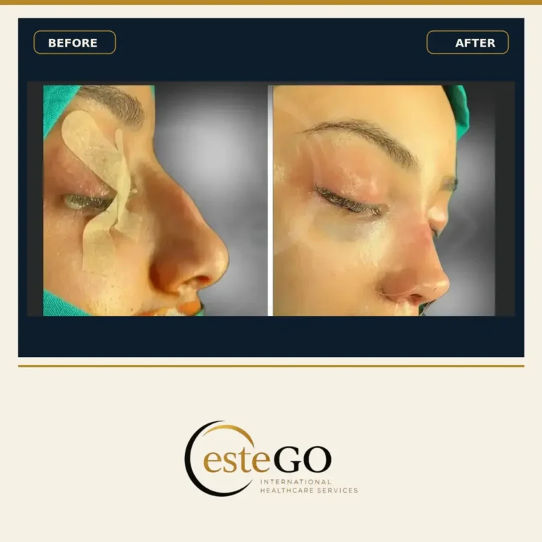 عملية تجميل الأنف قبل وبعد – منظر جانبي