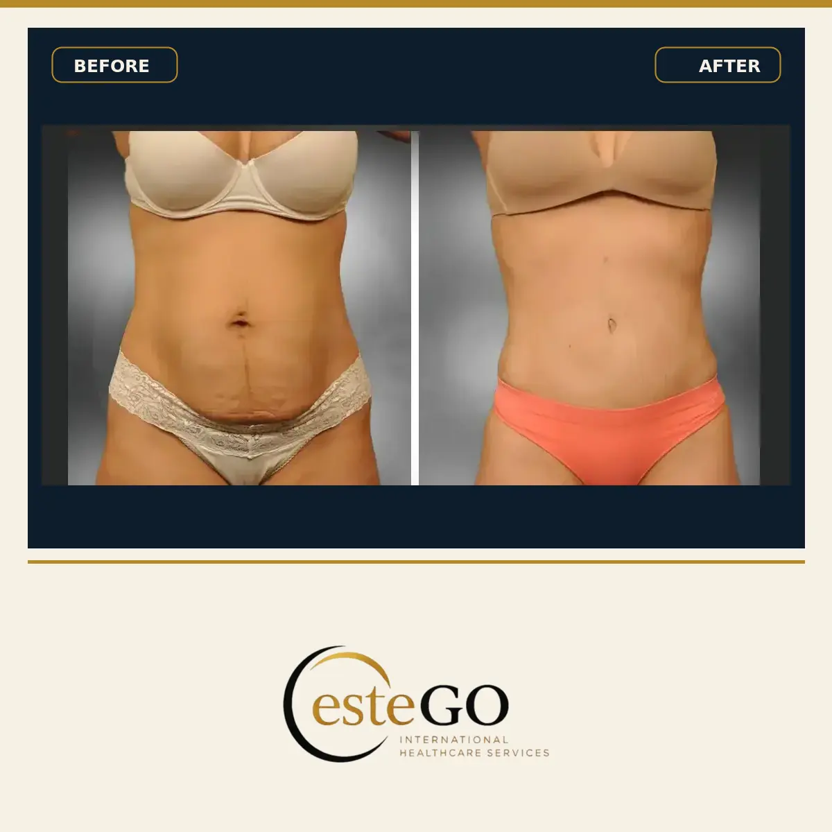 Karın germe önden öncesi ve sonrası – EsteGo Clinic