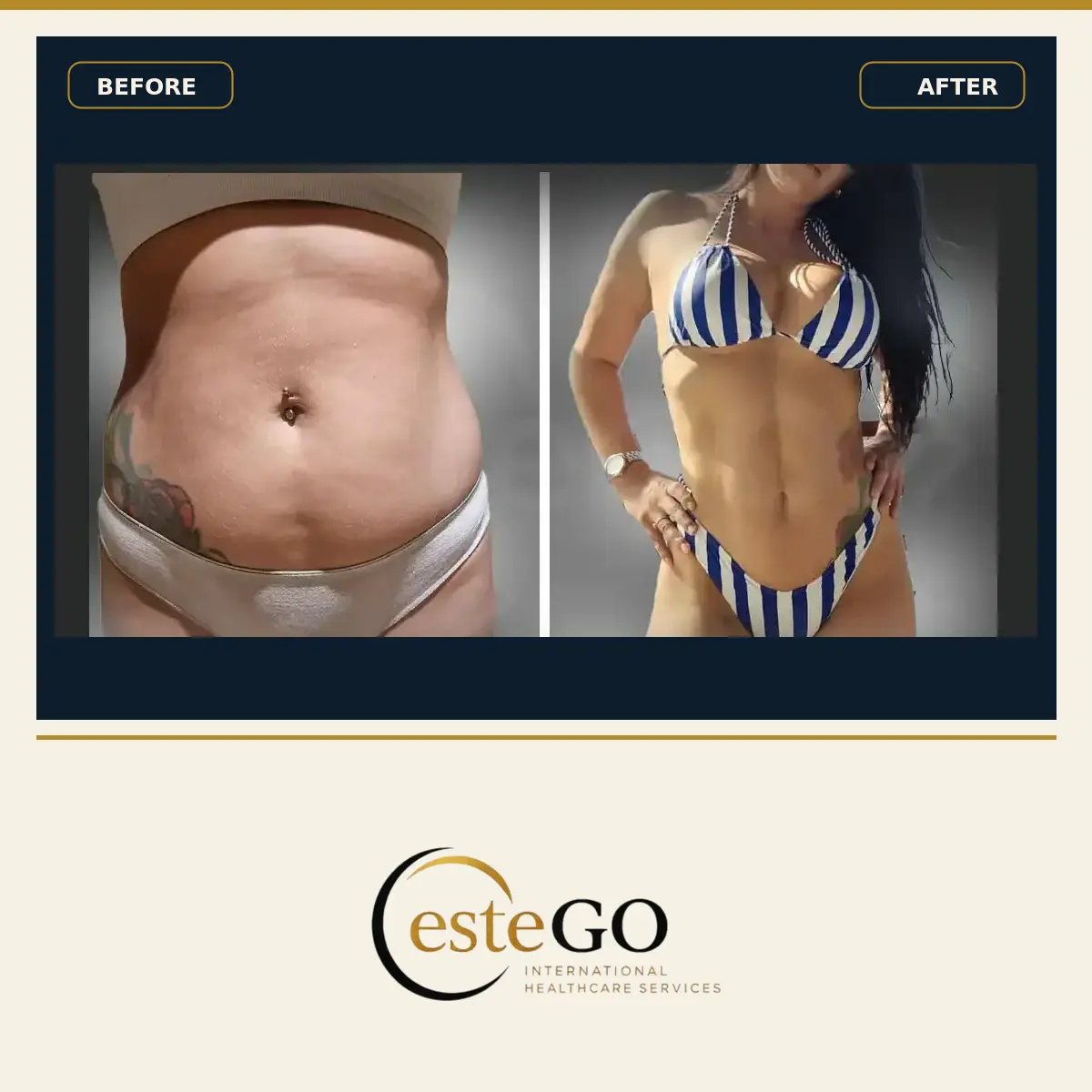 Liposuction karın ve bel öncesi sonrası – EsteGo Clinic