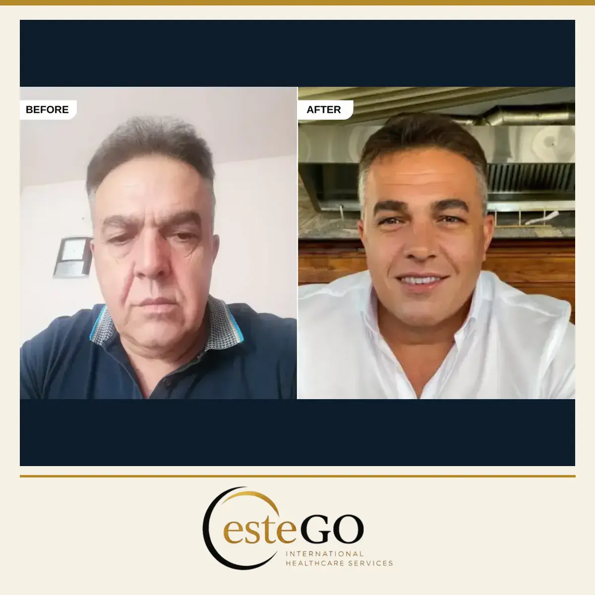 Yüz germe önden görünüm öncesi ve sonrası – EsteGo Clinic